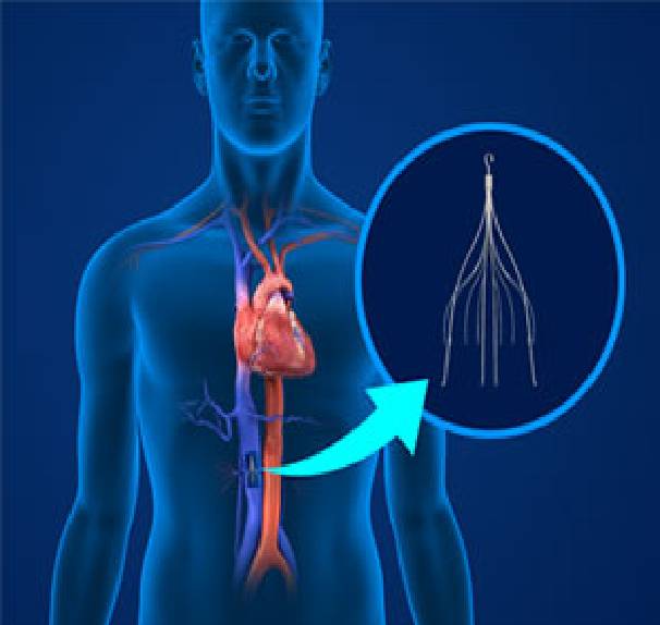 Inferior Vena Cava (IVC) Filter Placement and Retrieval