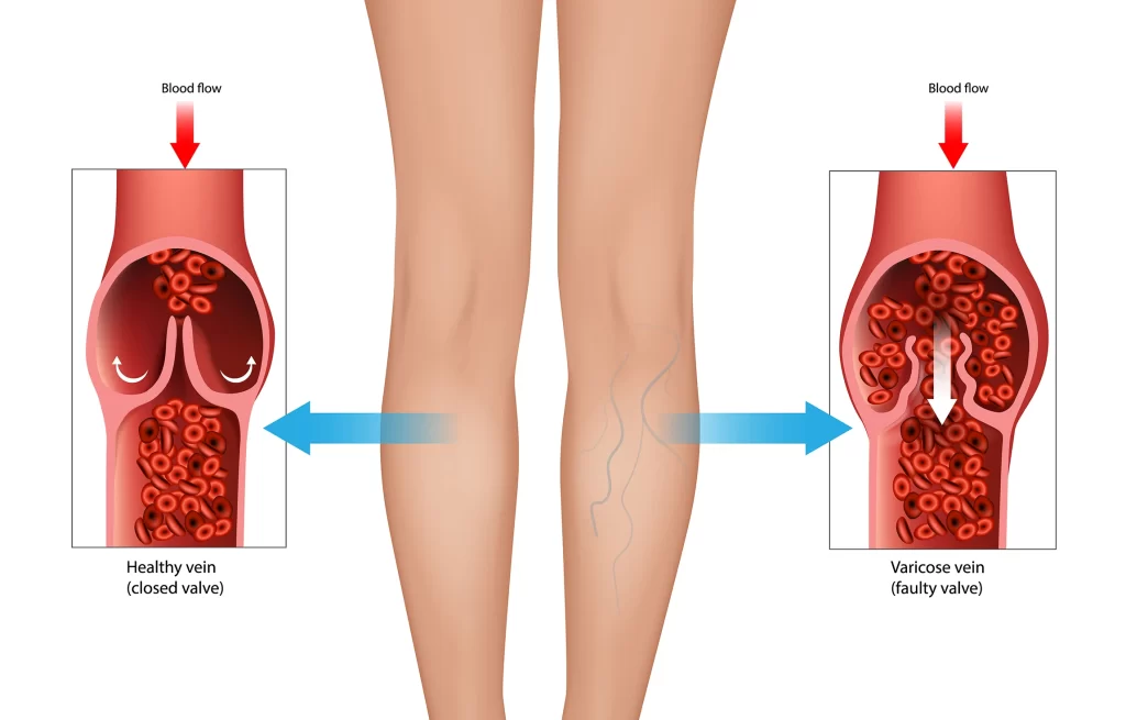 North County Vascular | Venous Insufficiency